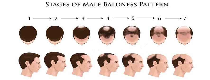 baldness-level