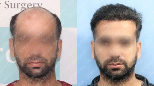 Best Hair Transplant result after 6 months using 2905 grafts in quick hair  transplant in India